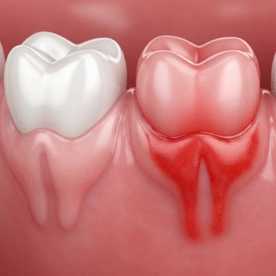 Close-up of healthy gums contrasted with red, swollen, and bleeding gums